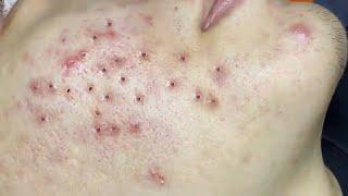 Loan Nguyen Acne Treatment 15u