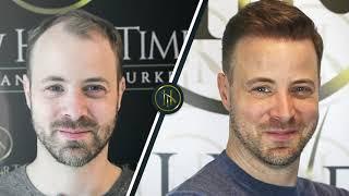 Hair Transplant Before and After | Hair Transplant Results