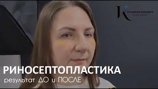 РИНОСЕПТОПЛАСТИКА - результат До и ПОСЛЕ - пластический хирург Владимир Косинец