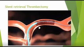 Acute Ischemic Stroke imaging and endovascular intervention #radiology      #neurointervention