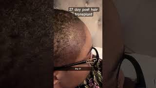 #hairtransplant #simi