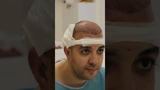 Fue Method Hair Transplantation