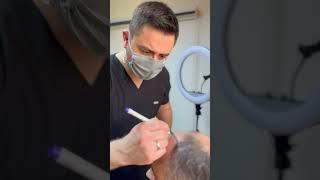 Saç ekimi nasıl yapılır? #sacekimi #hairtransplant #dolgu #istanbul Dermatolog Dr. Mustafa TÜMTÜRK