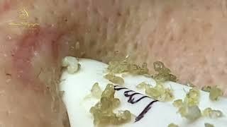 Loan Nguyen Acne Treatment 17766