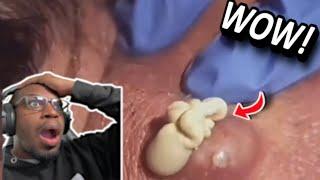 DO YOU SEE THE SIZE OF THE PIMPLE ON THEIR BACK! | Pimple Pooping and Blackhead Compilation