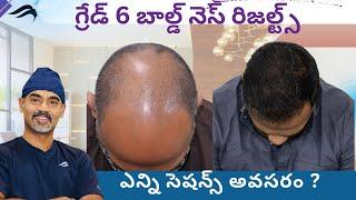 Hair Transplant In Hyderabad | Best Surgeon Center & Results Of Hair Transplant Surgery In Hyderabad