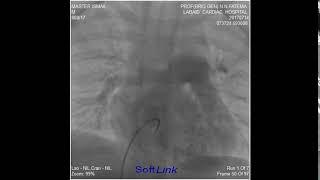 Baby Ismail 04 Yrs 15 Kg Severe PS BVP done by 16 x 3 Z Med II