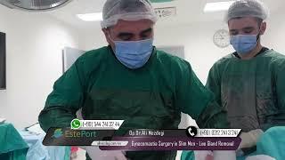 Gynecomastia Surgery in Slim Men - Live Gland Removal