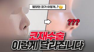 [코재수술 REVIEW] 짧고 들린 코, 재수술 후 대만족!