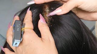 Gentle Scalp Check & Flake Pick ASMR  | Tingly Nail Scratching for Sleep #536