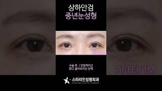 #상하안검 Before & After#중년눈성형 #리프팅 #리프팅전후 #상안검 #하안검 #중년눈수술 #눈성형 #눈처짐#동안수술 #수술전후 #스타라인 #스타라인성형외과 #눈매교정