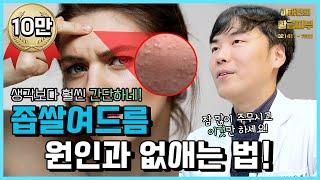 좁쌀여드름 없애기 이정도면 간단하게 성공할수 있어요 / 연세에이앤비 피부과 이해진원장