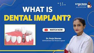 What Are Dental Implant? Procedure & Benefit - Dental Treatment in Agra, India | Dr Pooja Sharma