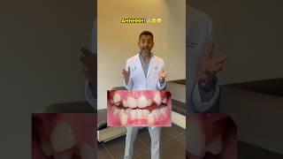 How Do You Align Crowded Teeth?