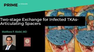 Two-stage Exchange for Infected TKAs- Articulating Spacers - Matthew P. Abdel, MD