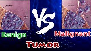 Benign Tumor Vs Malignant Tumor ( Clear Comparison )