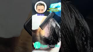 Hair Transplant 4000 Graft result after 1 year in Ilyas Arslan Hair Turkey #hair #skincare #duet