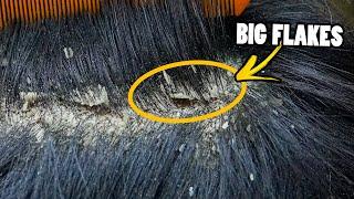 Big Flakes Scalp Scratching And Picking!! Huge Dandruff Removal At Home