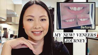 MY ULTRA THIN VENEERS JOURNEY, DENTAL IN THE PHILIPPINES | FILIPINO