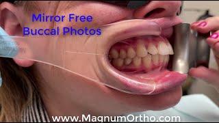 Mirror Free Buccal Photos - Deluxe Cheek Retractor