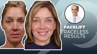 10 YEARS YOUNGER?! Traceless Facelift Surgery Before and After | Dr. David Stoker