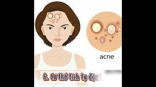 MỤN ĐẾN TỪ ĐÂU? {Nguyên Nhân Hàng Đầu Hình Thành Nên MỤN}