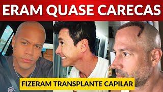 Famosos que já fizeram transplante capilar e você nem imaginava