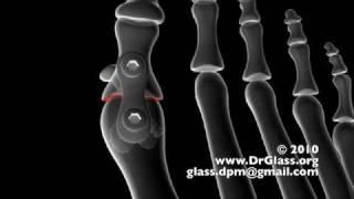 First Metatarsal Phalangeal Joint Fusion for Hallux Rigidus