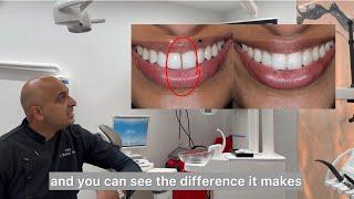 Teeth Straightening: Invisalign with cosmetic bonding By Dr Aleem