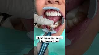 How to bond lower porcelain veneers