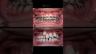 Braces very crooked #braces #orthodontist