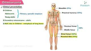 Osteosarcoma  : Orthopedic lectures