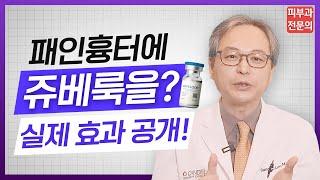 패인흉터 치료에  쥬베룩 해봤더니!!! 피부과전문의 실제 시술 후기‍️여드름 흉터