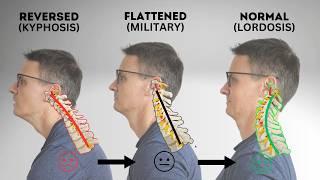 How to Fix Cervical Kyphosis, Flat Neck, or Military Neck | Neck Posture Fix