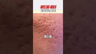 여드름 흉터 치료하는 방법 #패인흉터 #박스카 #박스흉터 #boxcar #boxscar