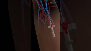 IV Insertion  IntraVenous Catheter ️ 3D Medical Animation Ep.1
