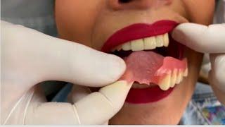 ¿TIENES PRÓTESIS DENTAL EN 2023? DEBERÍAS VER ESTE VIDEO ️