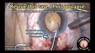 CataractCoach 1197: rescue this case of iris prolapse during cataract surgery
