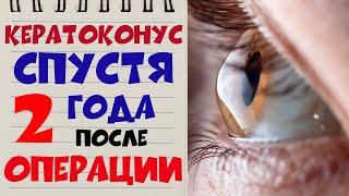  КЕРАТОКОНУС ‍️ Спустя 2 ГОДА после операции в клинике Арцыбашева в Будапеште 