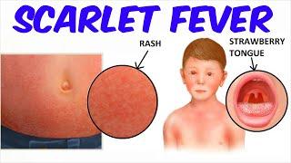 Scarlet Fever!