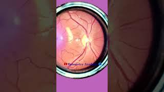 Normal fundus | Normal Retina | Smartphone Fundus Videography | Fundus Photography | Short Video 89