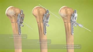 Exactech Equinoxe Fracture Plate Animation