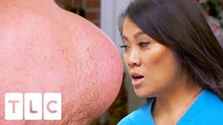 Dr Lee's HEAVIEST Lipoma Breaks The Internet! | Dr Pimple Popper