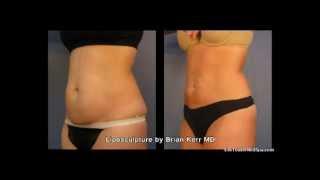 Liposuction Before and After Abdomen Area, Part 1 | Silk Touch Medspa Boise