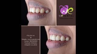 No prep Veneering| We Dental| Best Dental| Smile Design| Dr Arshad| Cosmetic dentistry| Spacing