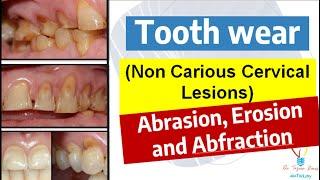 Tooth wear / Non carious cervical lesions. ABRASION vs EROSION vs ABFRACTION.