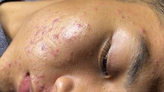 Acne Treatment Bo Nguyễn Spa| Acne On Teen Cheek 2024 #040