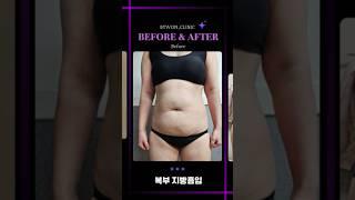 복부 지방흡입 후기 #복부지흡