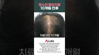 정수리 탈모 극복! 탈모치료, 모낭주사 효과ㅣ10개월 전후ㅣ뉴헤어