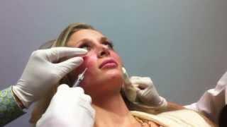 Blunt micro-cannula technique for under eye (tear trough) and cheek, Mrs of USA, Steve Weiner, MD